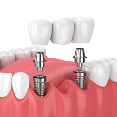Multiple dental implants